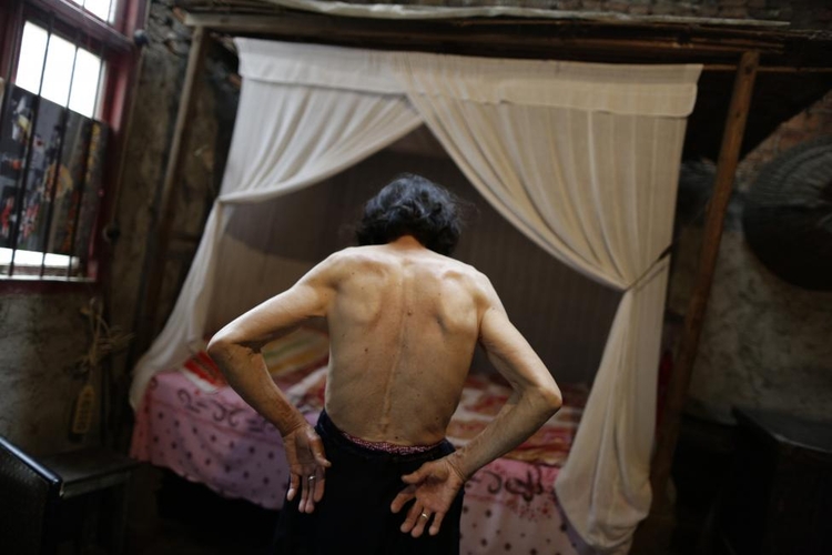 fot. Jason Lee / Reuters / 23 czerwca 2014  Shimen, Chiny  78-letnia Qin Zhengyu pokazuje znamiona i guzy na plecach.